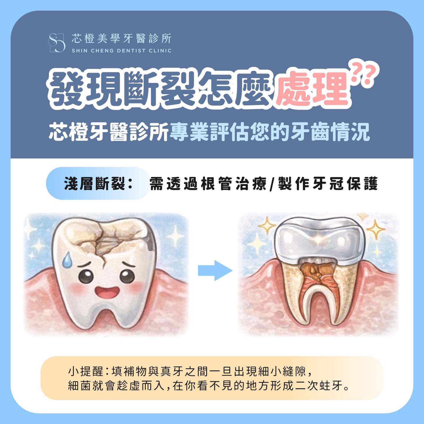 當牙齒補得越來越大,真的就比較安全嗎?其實大範圍填補,反而可能藏著你沒注意到的隱形危機|原站文章圖片