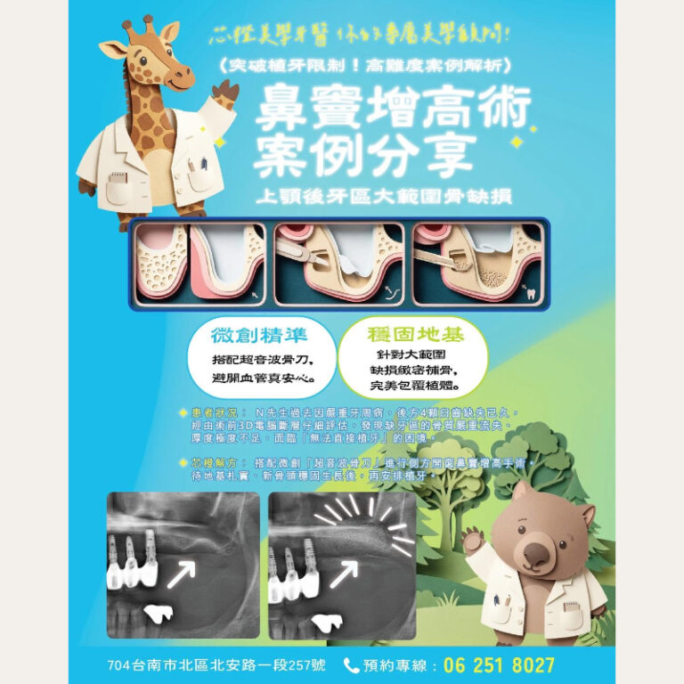 【突破植牙限制!高難度案例解析:鼻竇增高術】|文章封面