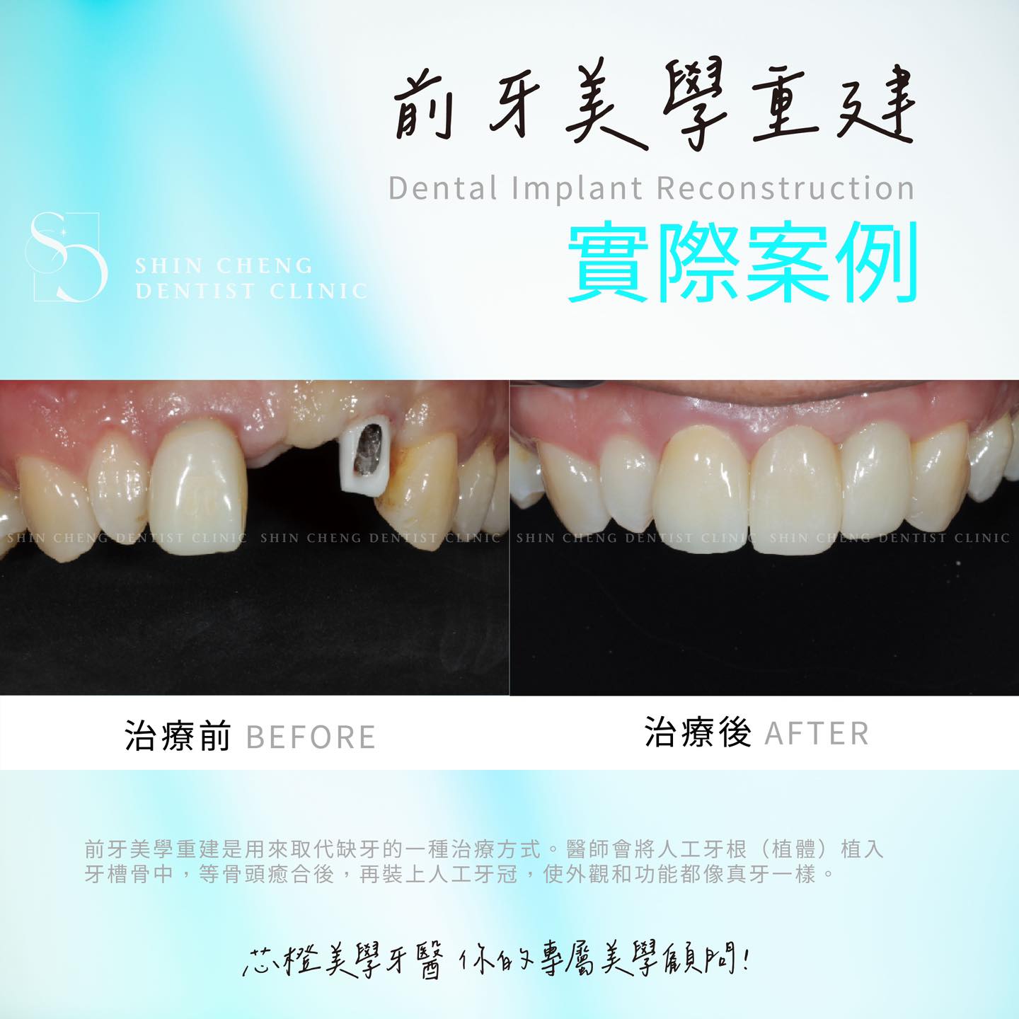 \前牙美學重建—重拾自信笑容!/|原站文章圖片