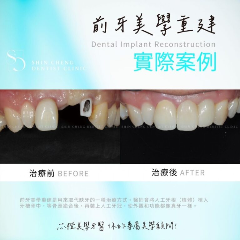 \前牙美學重建—重拾自信笑容!/|文章封面