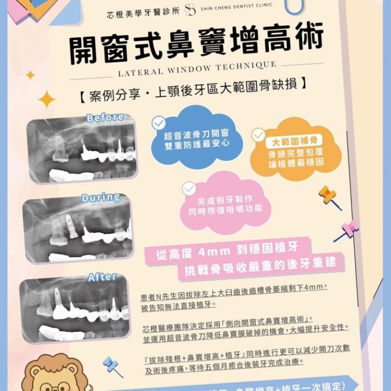 因拔除後牙等待多時,準備植牙時發現地基流失太嚴重,被告知無法直接植牙…|文章封面