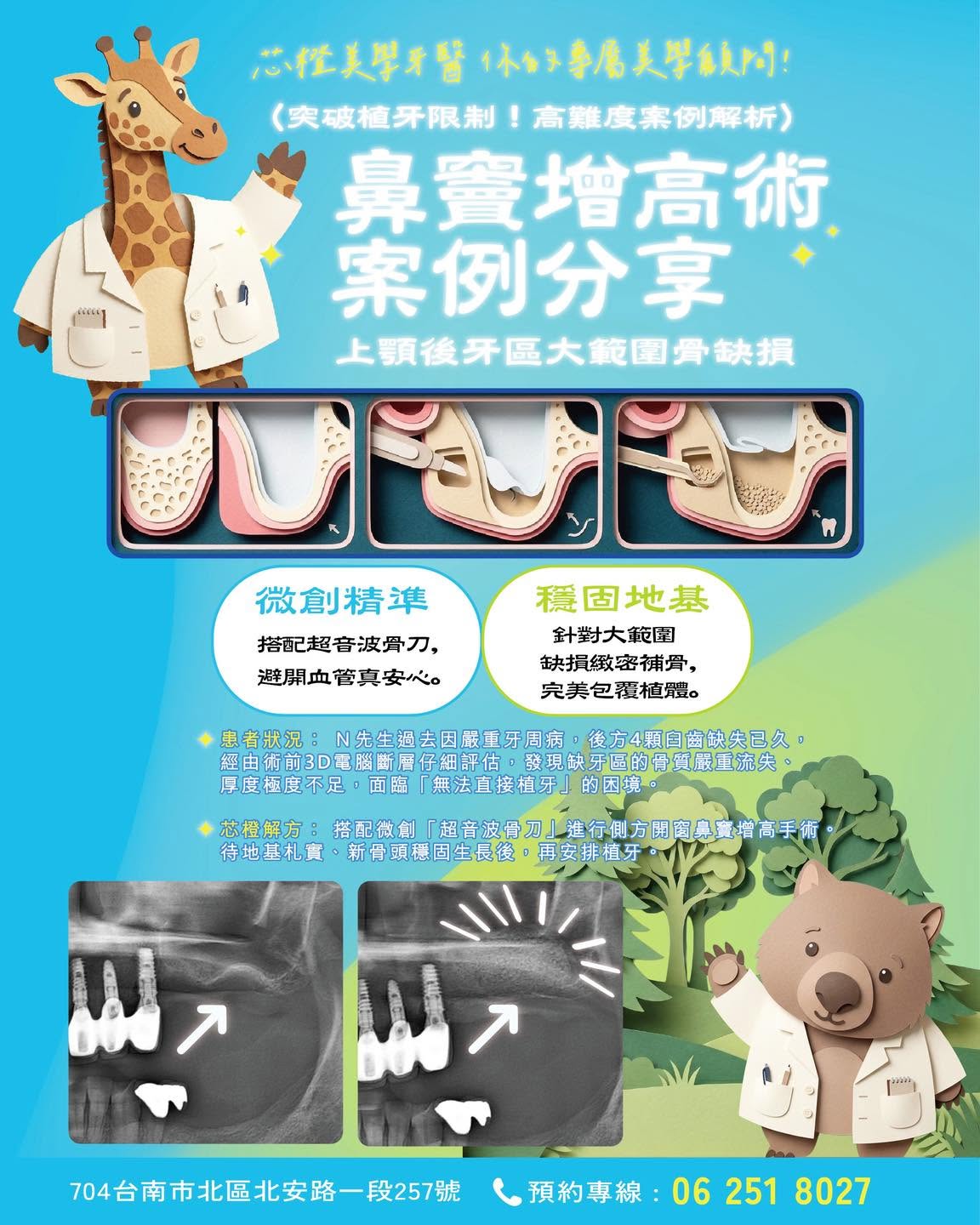 【突破植牙限制!高難度案例解析:鼻竇增高術】|原站文章圖片