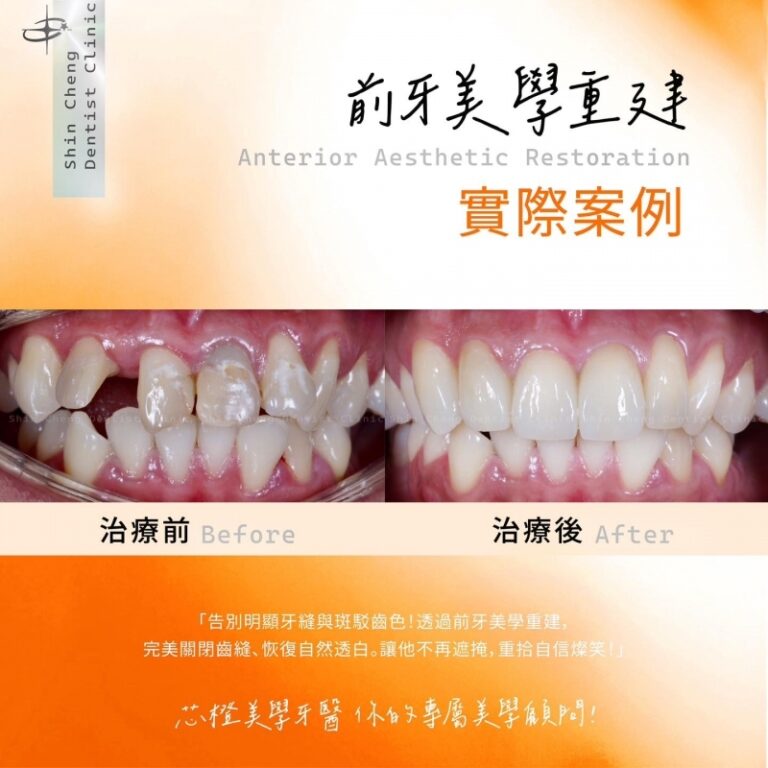 無濾鏡直出!一次解決「牙縫過大」與「嚴重色差」|文章封面