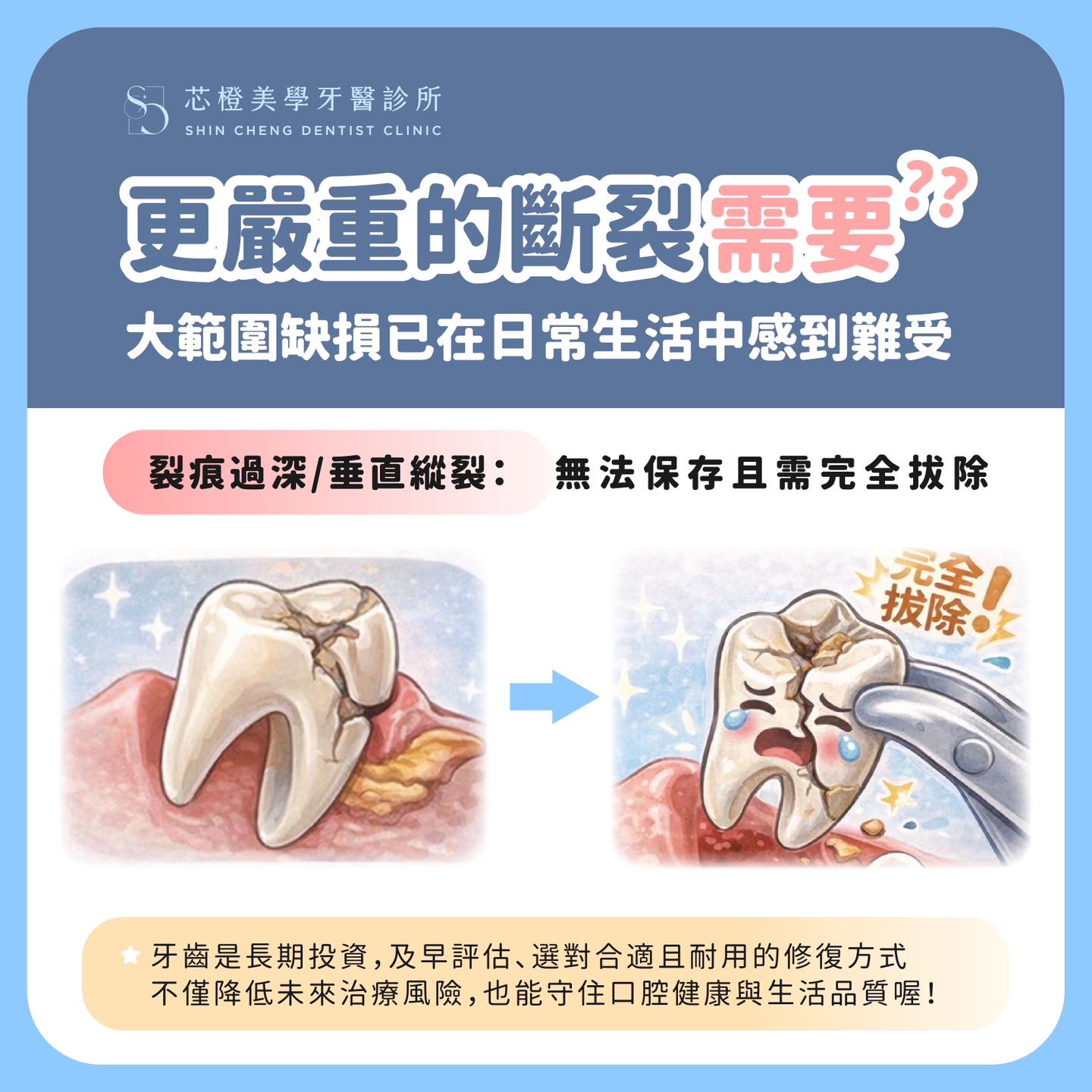 當牙齒補得越來越大,真的就比較安全嗎?其實大範圍填補,反而可能藏著你沒注意到的隱形危機|原站文章圖片