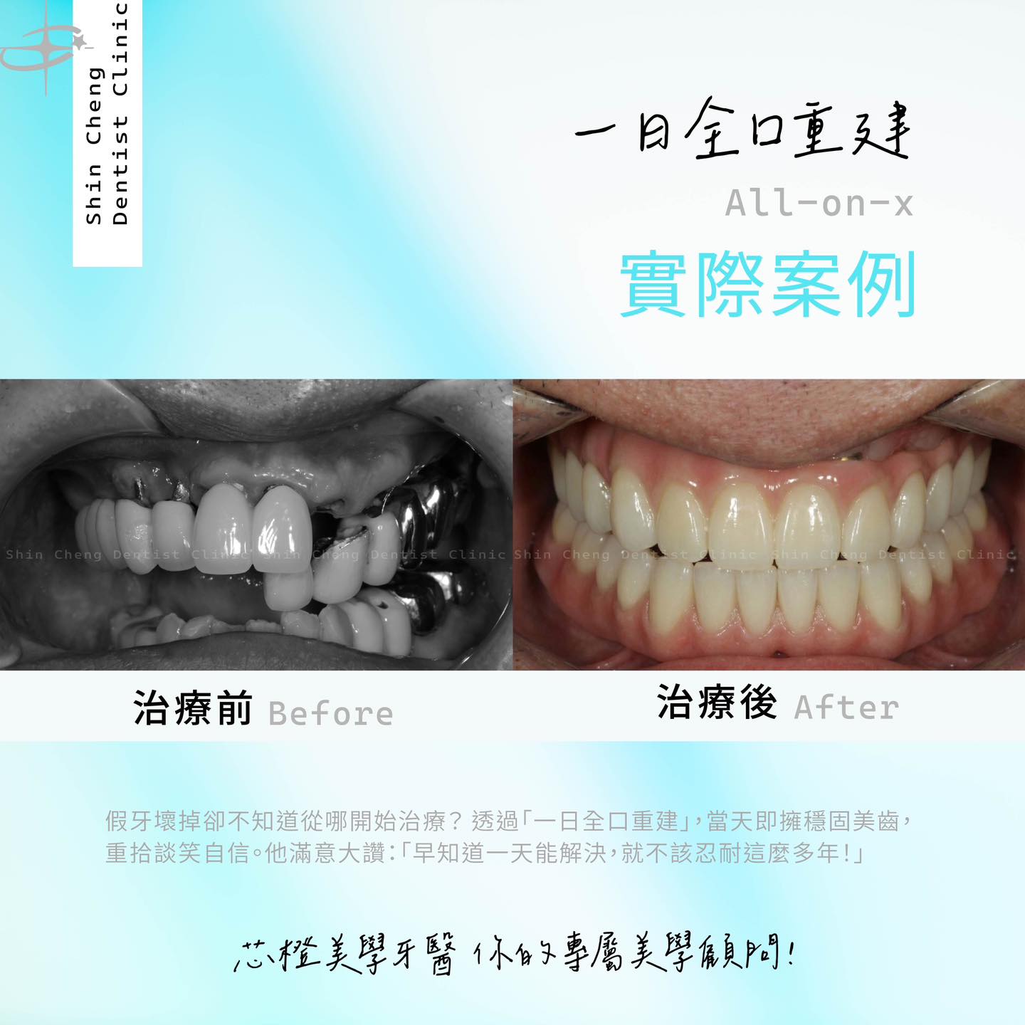 假牙壞了怎麼辦?別忍耐!「一日全口重建」找回您的穩固美齒|原站文章圖片