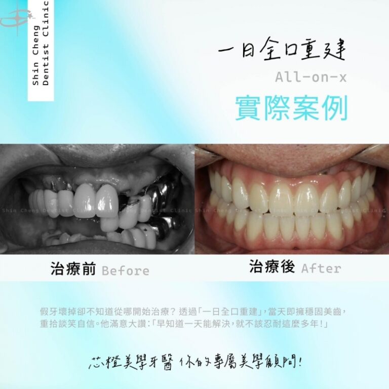 假牙壞了怎麼辦?別忍耐!「一日全口重建」找回您的穩固美齒|文章封面